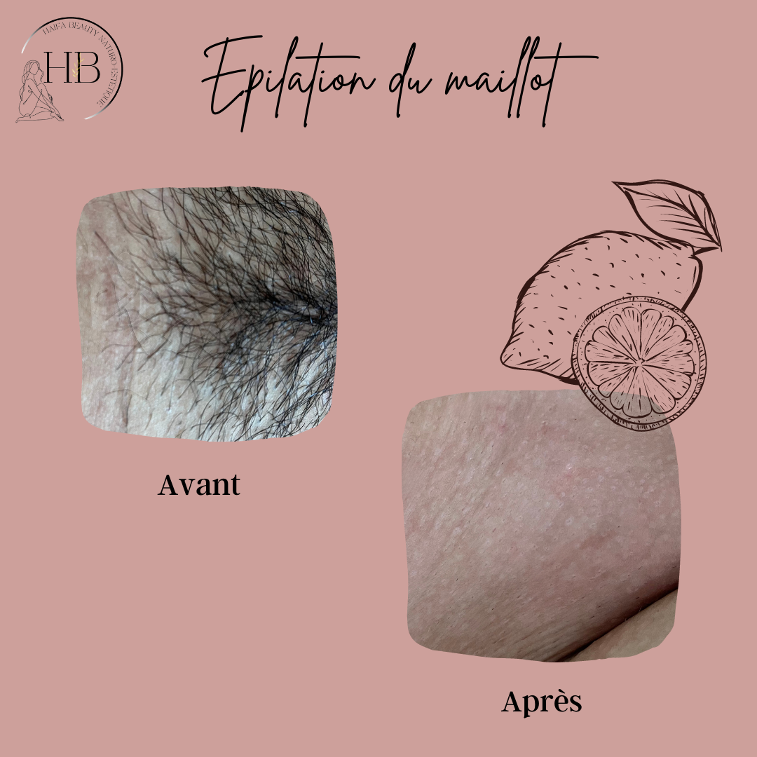 EPILATION ORIENTALE DU MAILLOT INTEGRAL