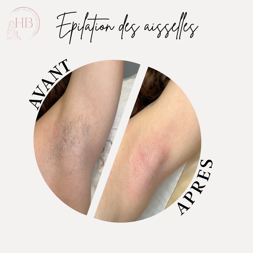 EPILATION ORIENTALE DES AISSELLES
